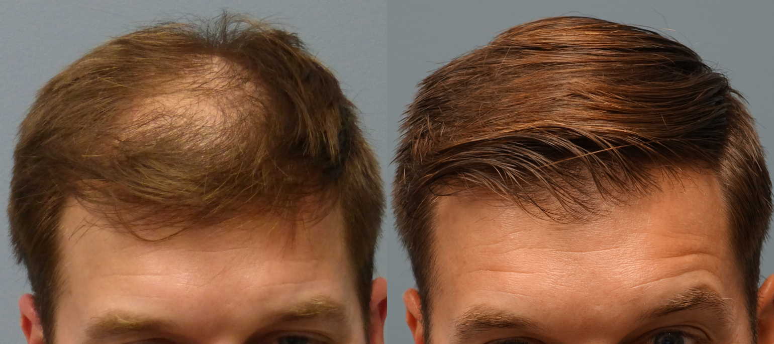 before-and-after-neograft-hair-transplant-