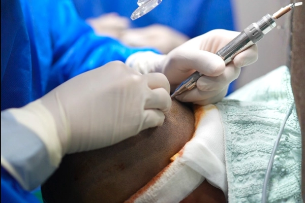 Implantation Process