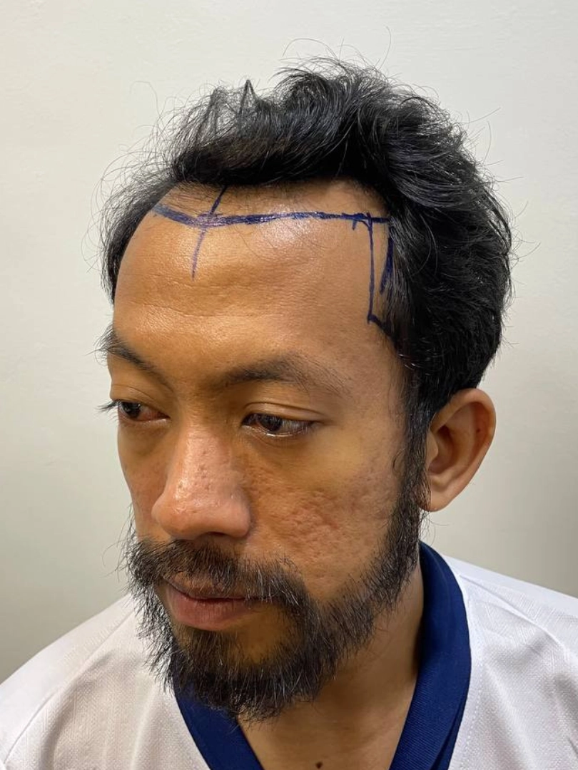 M-Shape Hair Transplant