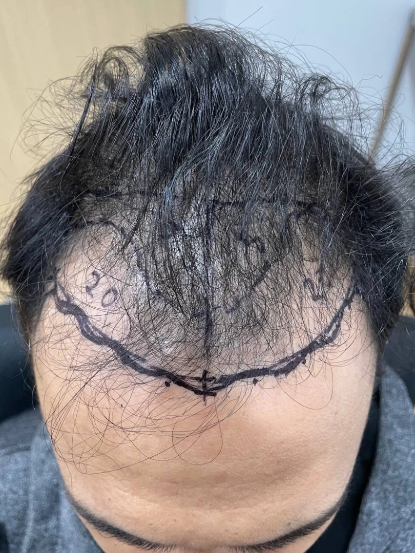 Corrective Hair Transplant
