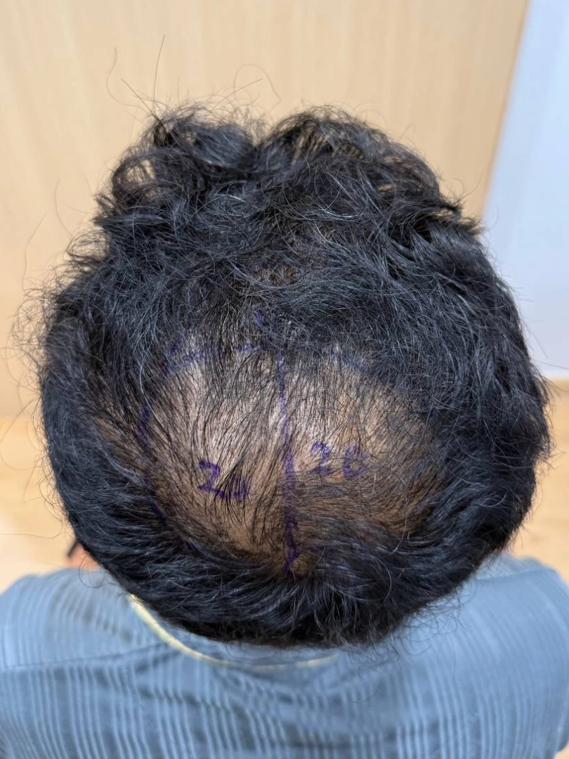 Crown Hair Transplant