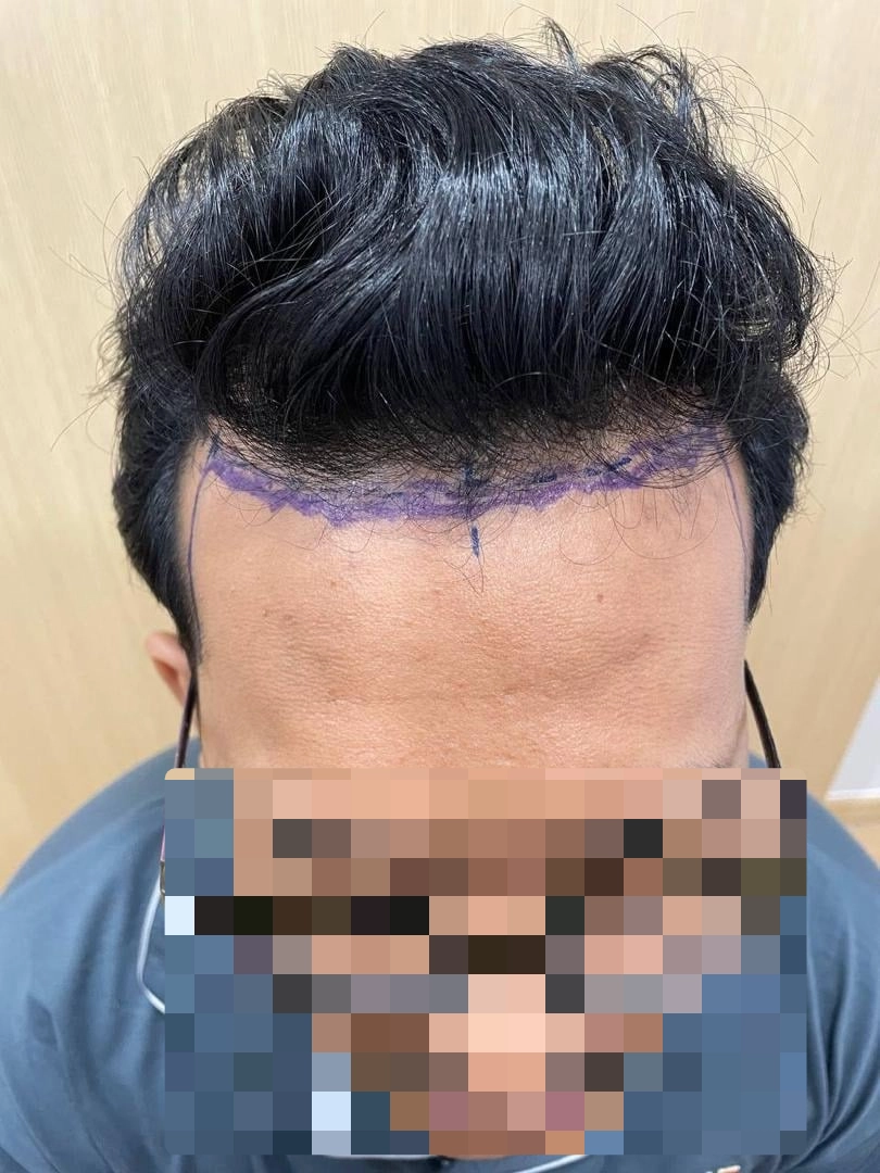 Hairline Hair Transplant